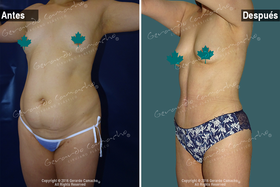 Paciente sonriendo tras abdominoplastia en Bogotá